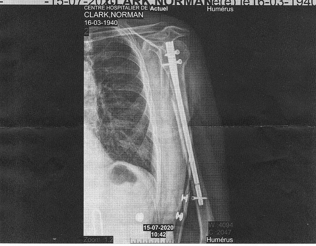 arm x-ray.jpg
